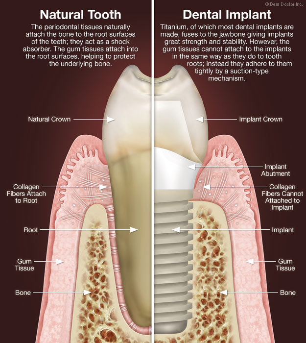 A Medical Illustration of a Natural Tooth and Dental Implants | Dental Implants in Indiana