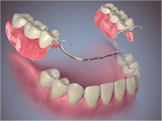 A partial denture | Same-Day Dentures | Aegis Dental Group or Angola Dental Center