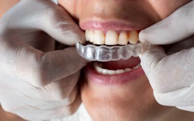 Retainers vs Braces: What You Need To Know