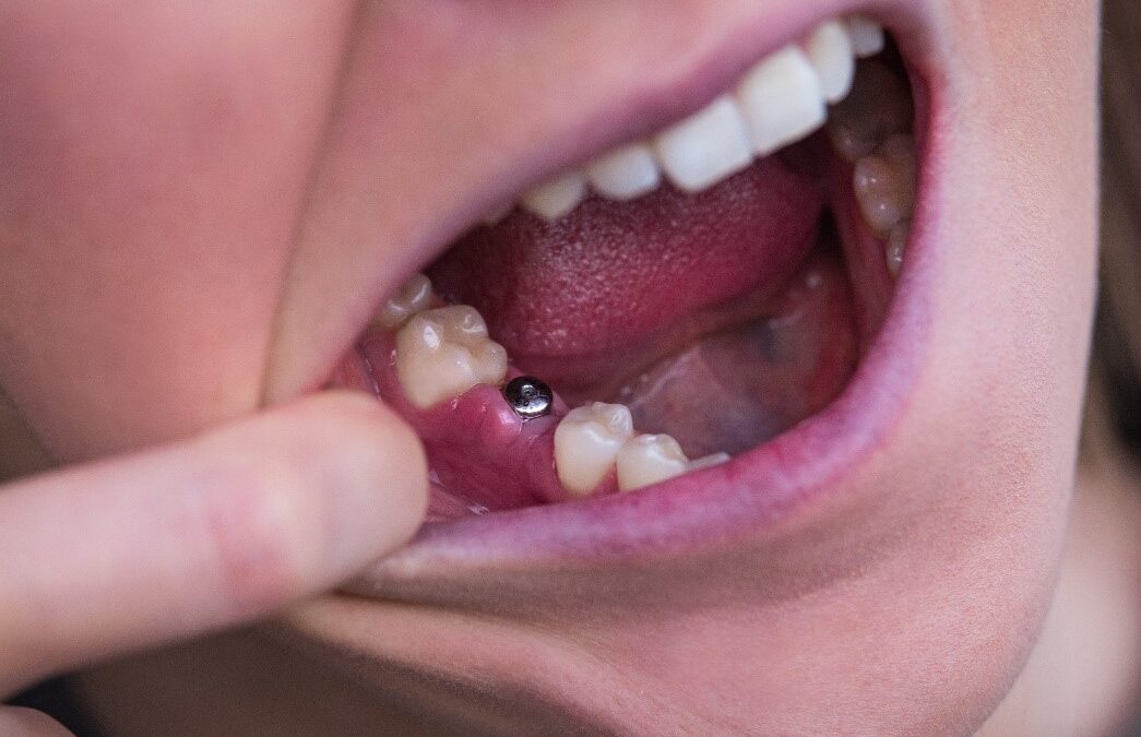 Signs of Dental Implant Failure