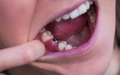 Signs of Dental Implant Failure