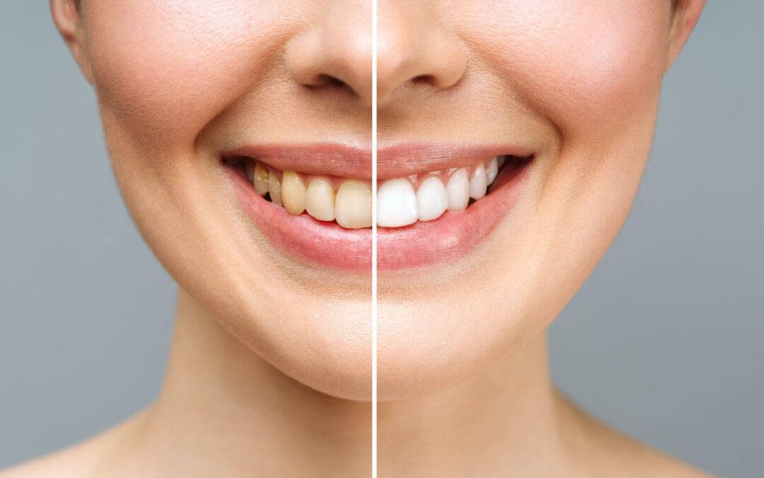 Teeth Whitening Dos and Don’ts