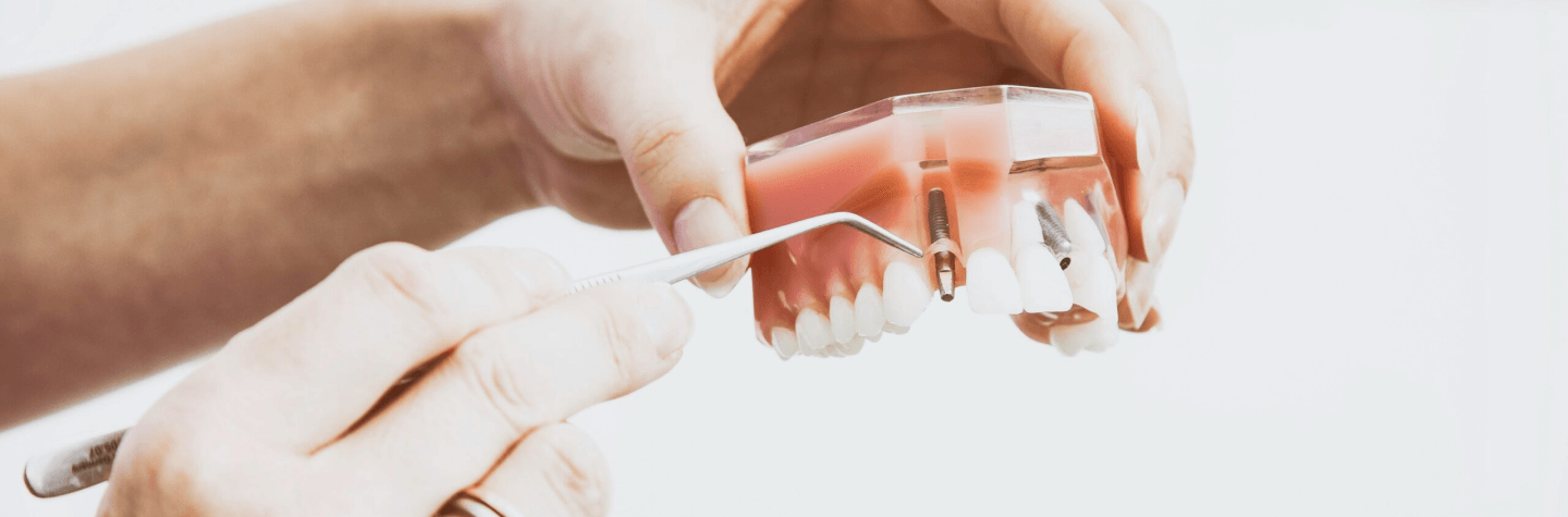 Indiana dental implants