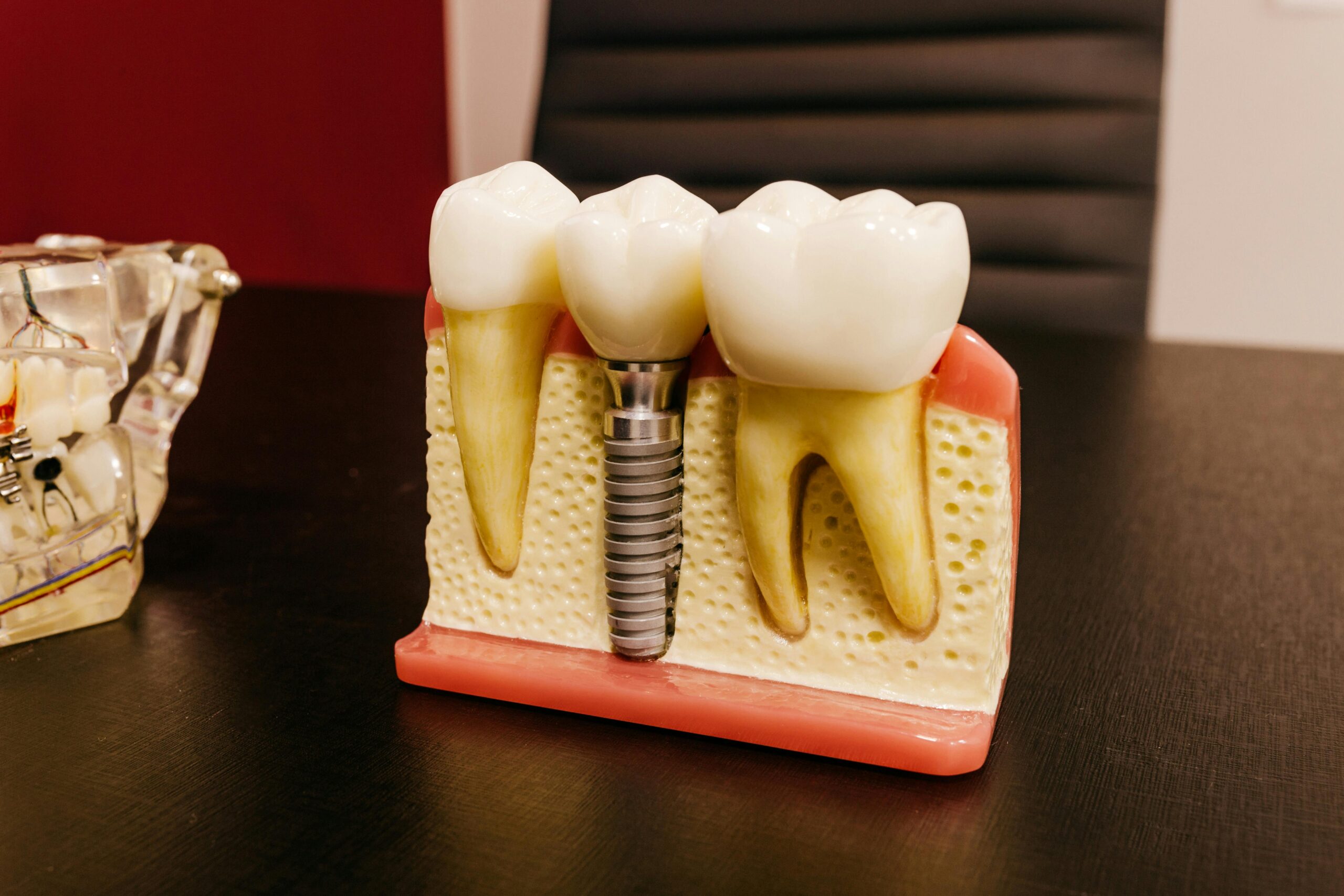 what are dental implants