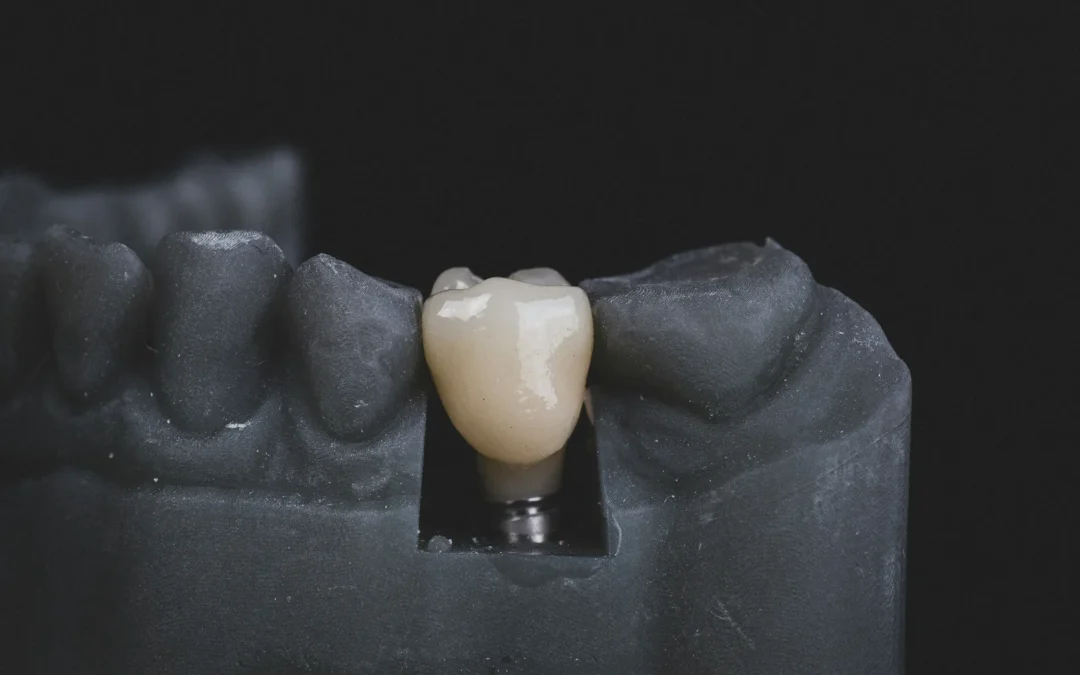 What are the Downsides of Dental Implants