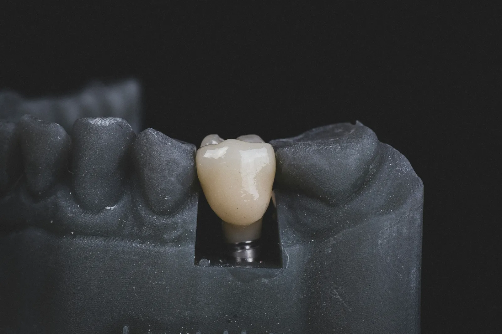 root canal treatment