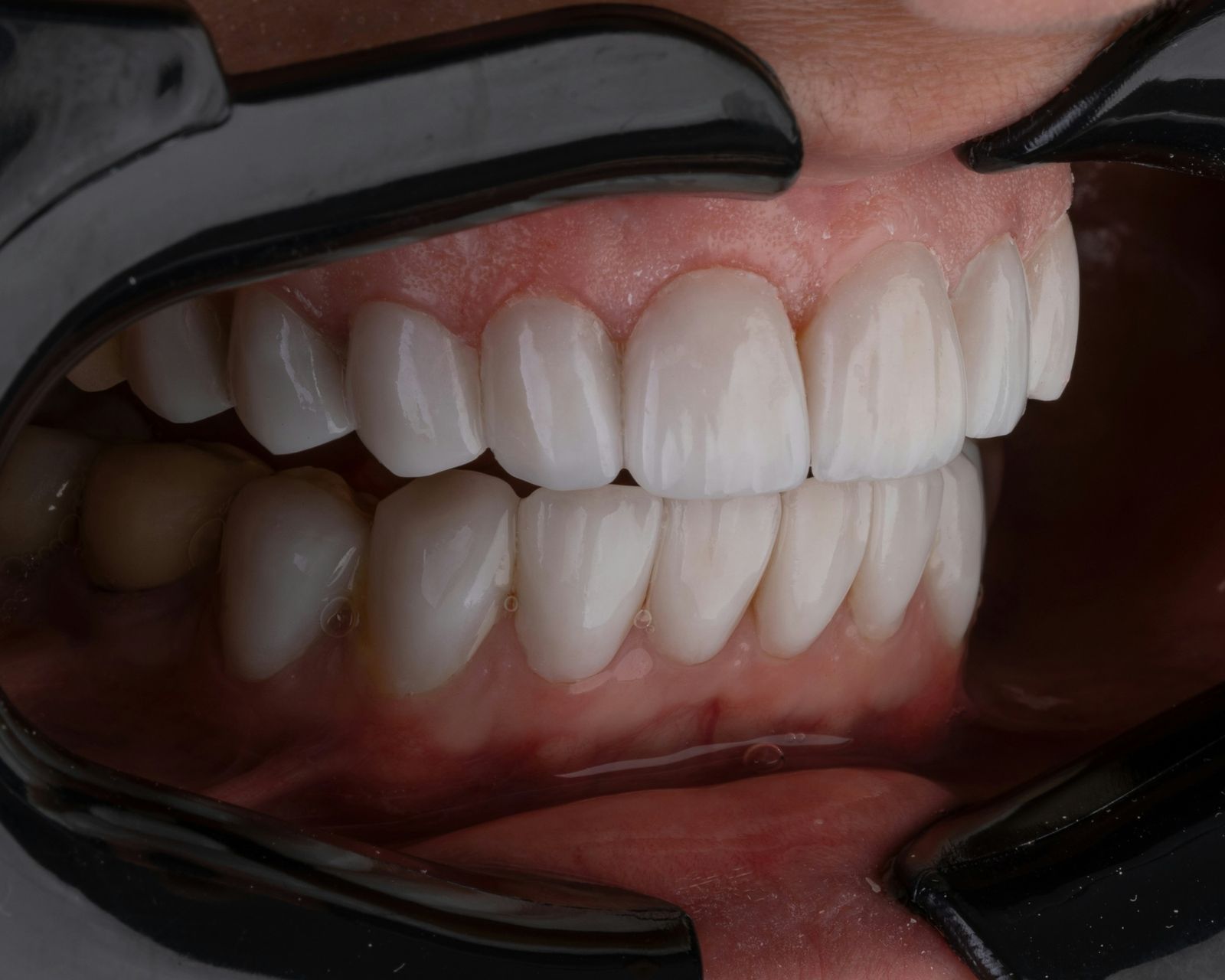 root canal treatment