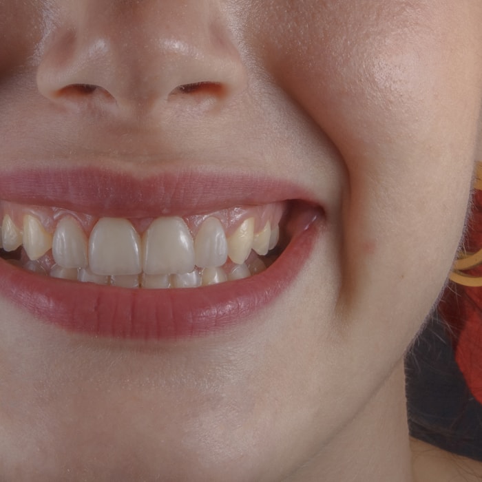 root canal treatment root canal treatment