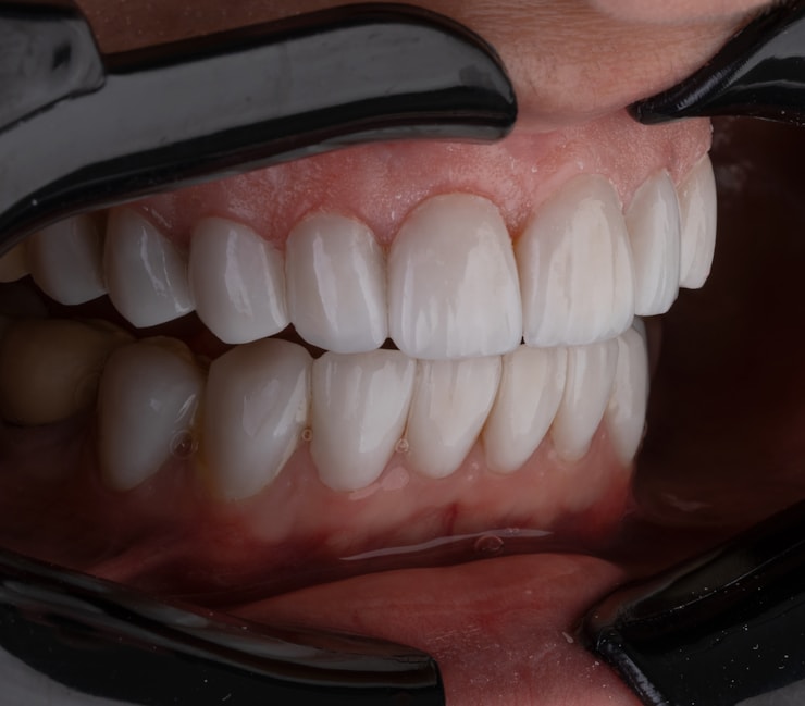 root canal treatment root canal treatment
