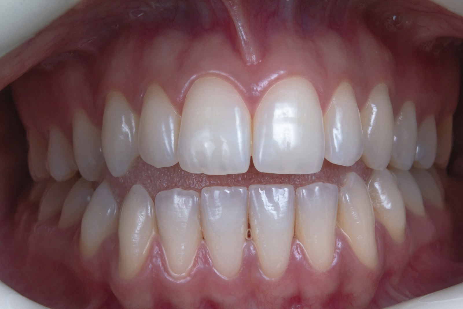 root canal treatment root canal treatment